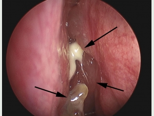 Frontal sinus blocked by infection and nasal polyps.